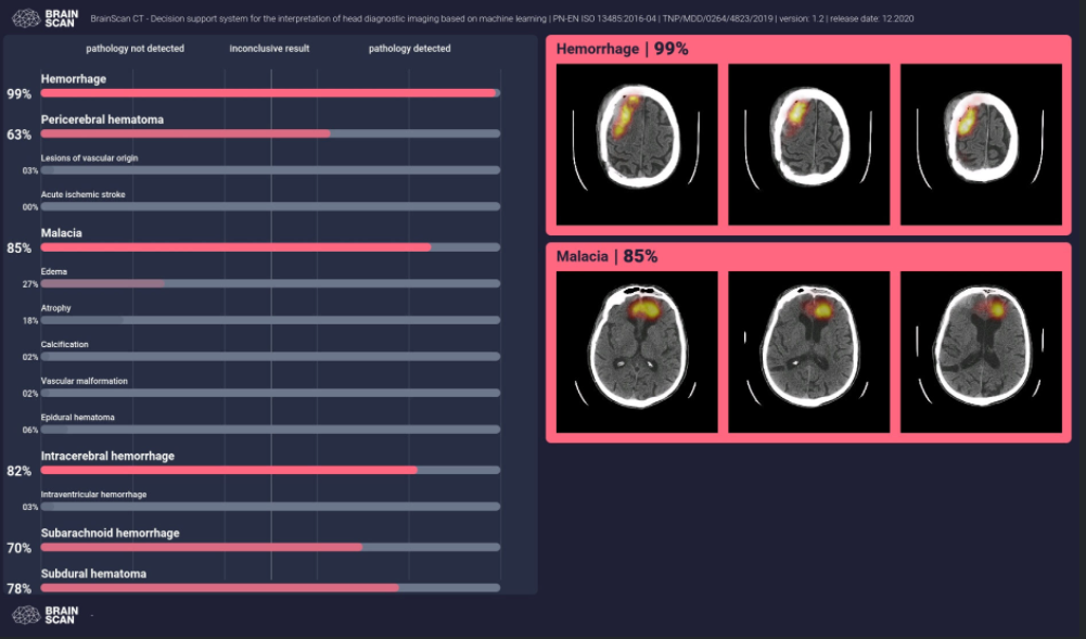 zdjęcia przedstawia interfejs oprogramowania do wykrywania zmian neurologicznych. Na ekranie widać wykresy oraz skany 6 mózgów z różnymi przypadłościami neurologicznymi